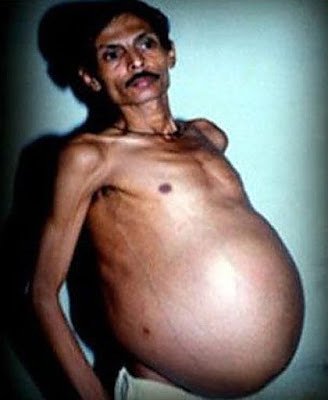 Sanju Bhagat zawsze wyglądał, jakby był w ostatnich miesiącach ciąży.